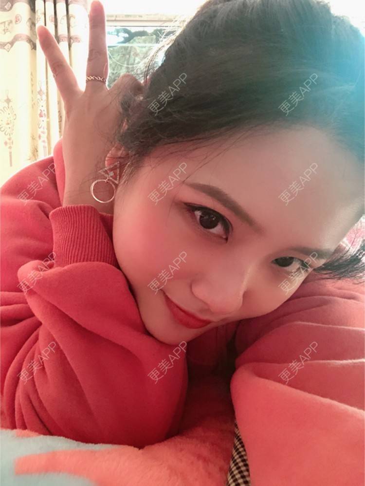 更美 - 奥多Ke。的植发际线经验 | 植发际线 | 南昌