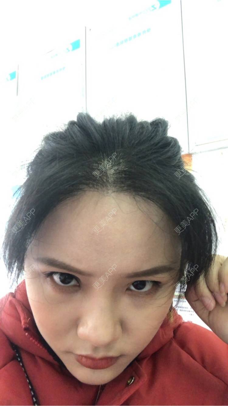 更美 - 奥多Ke。的植发际线经验 | 植发际线 | 南昌