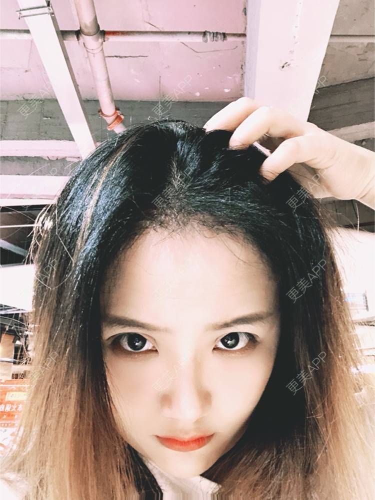 更美 - 奥多Ke。的植发际线经验 | 植发际线 | 南昌