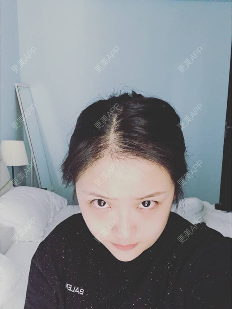 更美 - 奥多Ke。的植发际线经验 | 植发际线 | 南昌