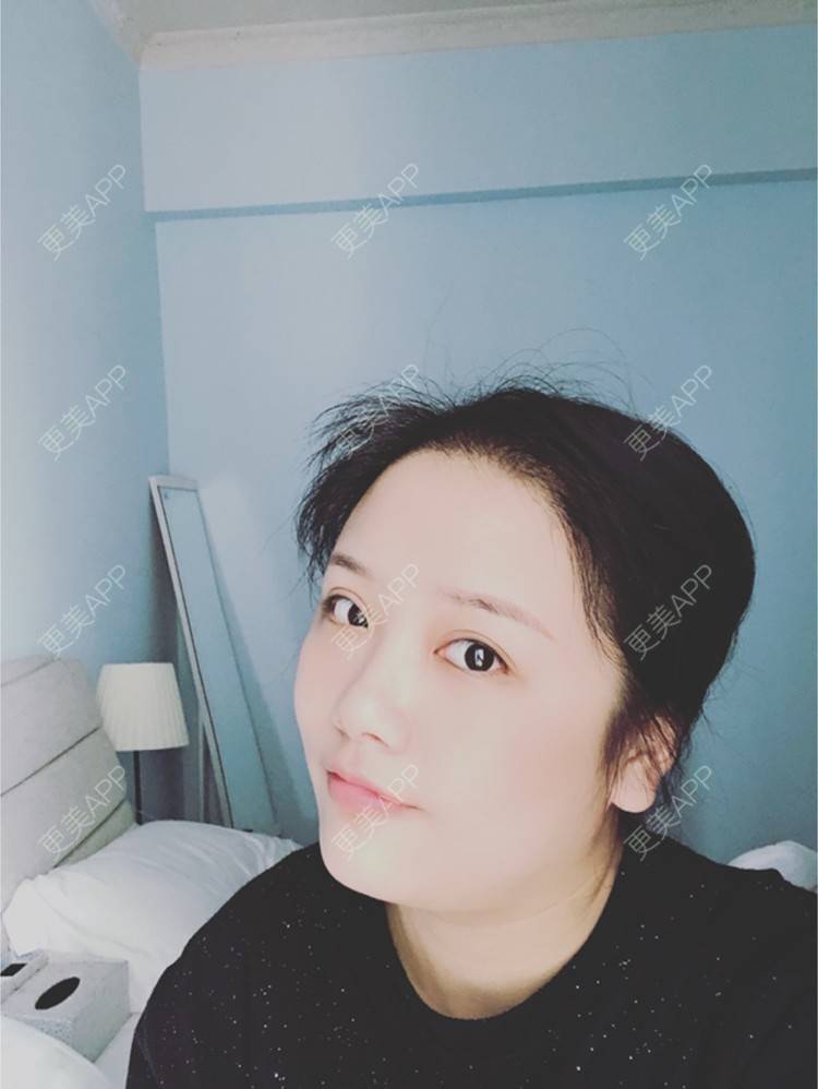 更美 - 奥多Ke。的植发际线经验 | 植发际线 | 南昌