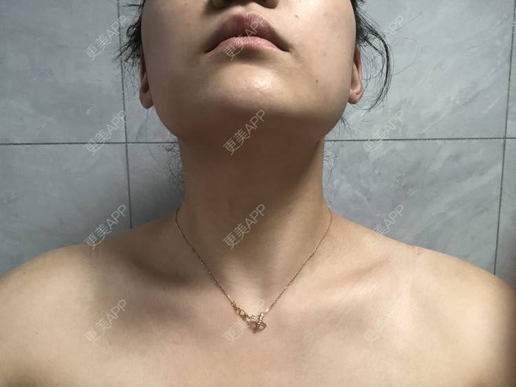更美 - 阿发4.1的注射塑形腿部经验 | 注射塑形腿部 | 上海