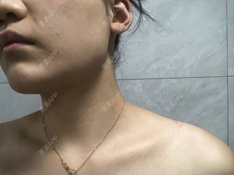 更美 - 阿发4.1的注射塑形腿部经验 | 注射塑形腿部 | 上海