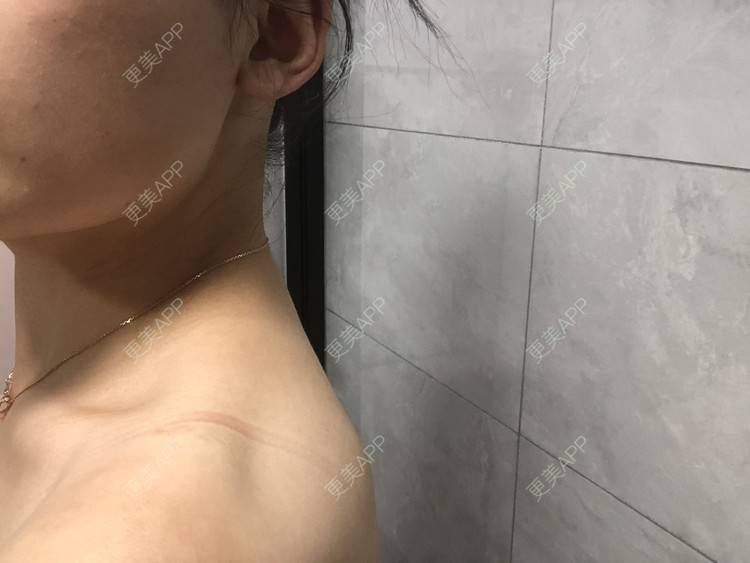 更美 - 阿发4.1的注射塑形腿部经验 | 注射塑形腿部 | 上海