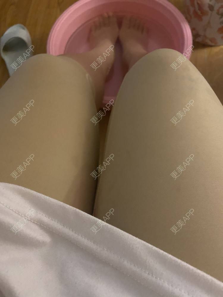 更美 - _ViViLee的吸脂经验 | 吸脂瘦大腿 | 射频溶脂瘦大腿 | 吸脂 | 上海