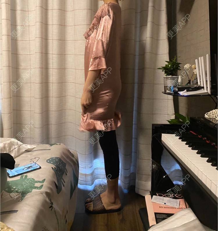 更美 - 玉琼#的自体脂肪丰臀经验 | 自体脂肪丰臀 | 上海