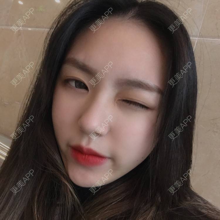 更美 - 吃飯從來用湯勺√的自体脂肪隆鼻经验 | 成都 | 自体脂肪隆鼻 | 视频日记