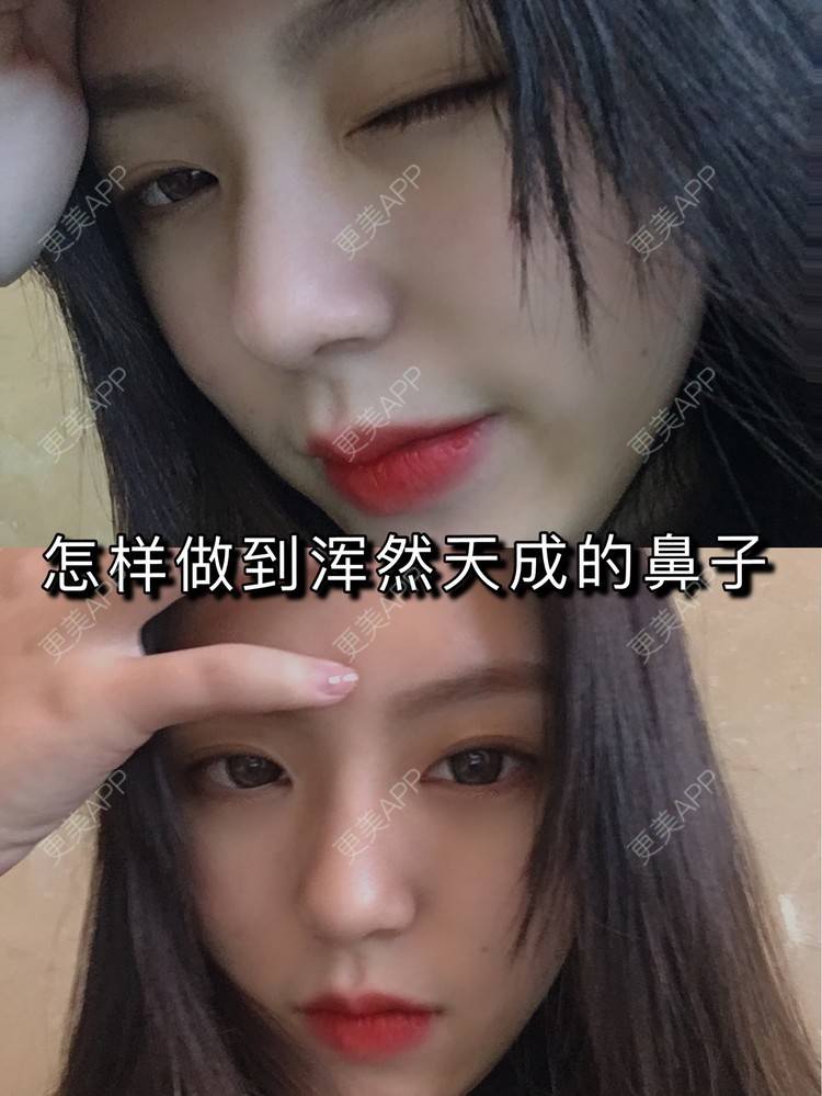 更美 - 吃飯從來用湯勺√的自体脂肪隆鼻经验 | 成都 | 自体脂肪隆鼻 | 视频日记