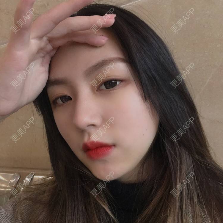 更美 - 吃飯從來用湯勺√的自体脂肪隆鼻经验 | 成都 | 自体脂肪隆鼻 | 视频日记