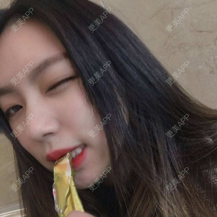 更美 - 吃飯從來用湯勺√的自体脂肪隆鼻经验 | 成都 | 自体脂肪隆鼻 | 视频日记