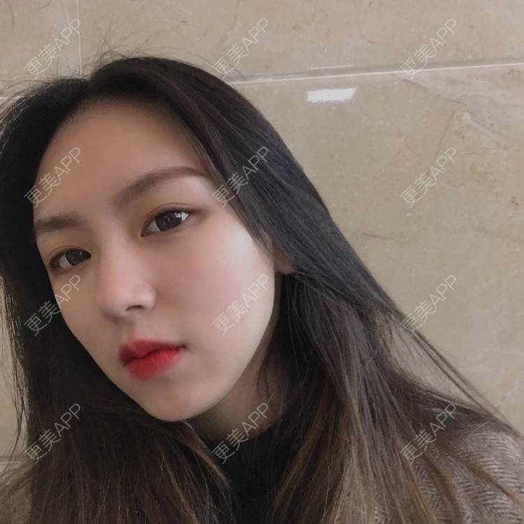 更美 - 吃飯從來用湯勺√的自体脂肪隆鼻经验 | 成都 | 自体脂肪隆鼻 | 视频日记