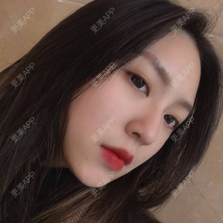 更美 - 吃飯從來用湯勺√的自体脂肪隆鼻经验 | 成都 | 自体脂肪隆鼻 | 视频日记