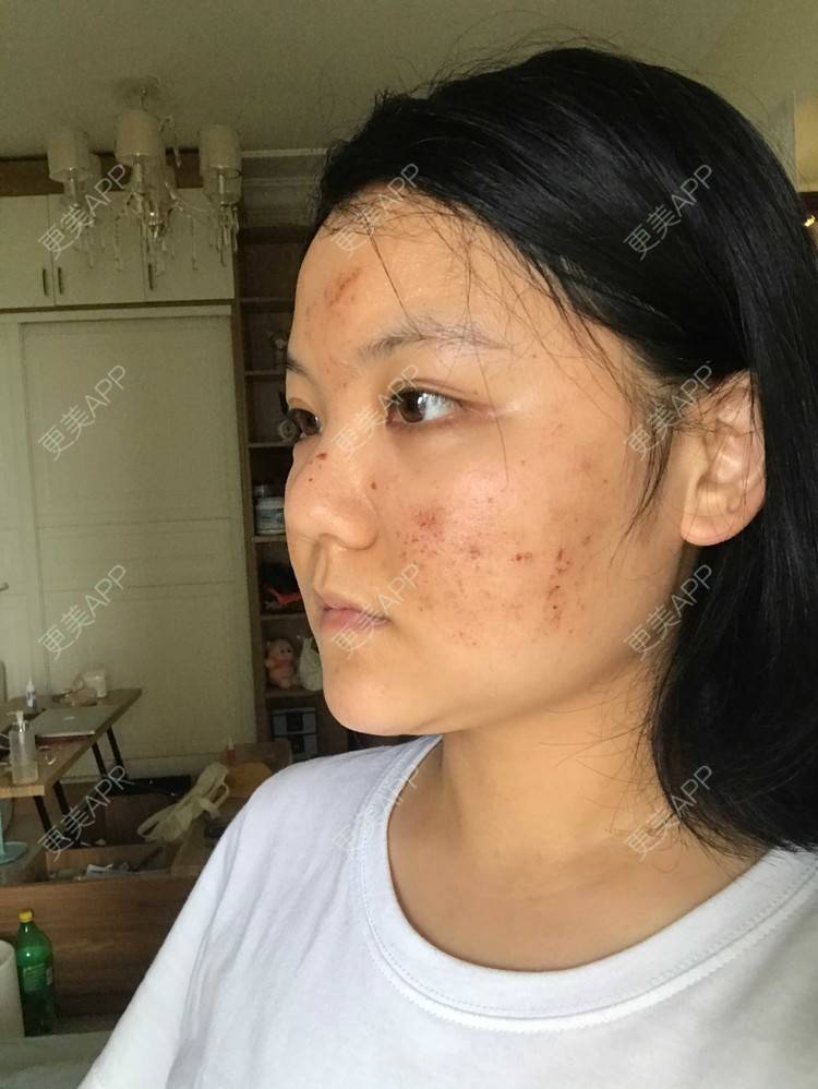 更美用户kcaklamodw的祛疤痕痘印日记