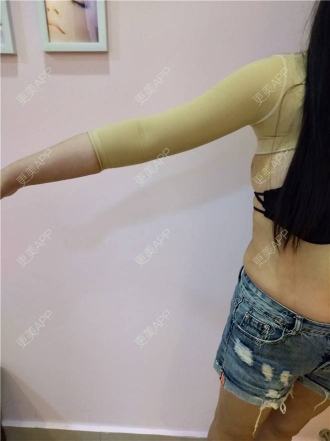 更美 - 更美用户VWYryf2A9C的射频溶脂瘦手臂经验 | 射频溶脂瘦手臂