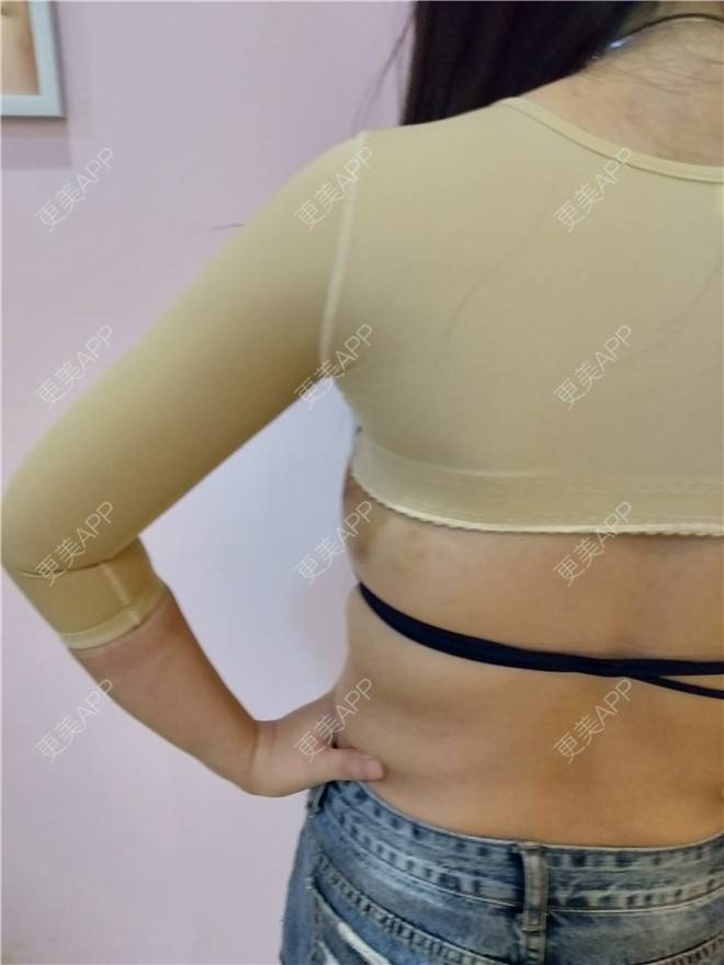 更美 - 更美用户VWYryf2A9C的射频溶脂瘦手臂经验 | 射频溶脂瘦手臂