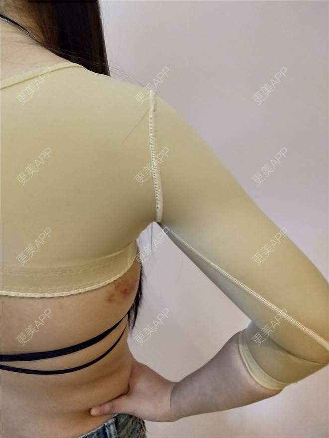 更美 - 更美用户VWYryf2A9C的射频溶脂瘦手臂经验 | 射频溶脂瘦手臂