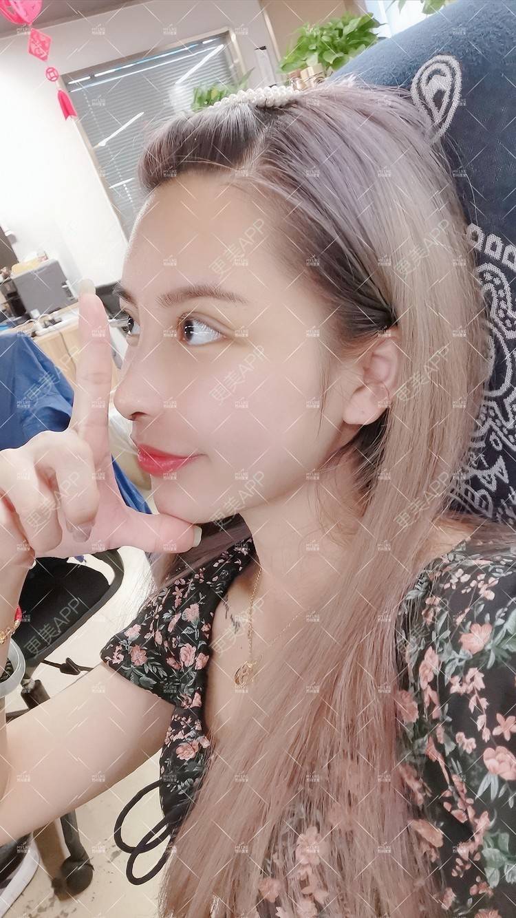 更美 - 土豆泥泥泥的双眼皮经验 | 双眼皮 | 隆鼻 | 苏州 | 自体脂肪面部填充