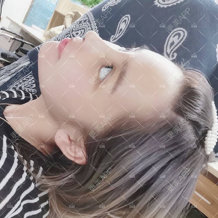 更美 - 土豆泥泥泥的双眼皮经验 | 双眼皮 | 隆鼻 | 苏州 | 自体脂肪面部填充