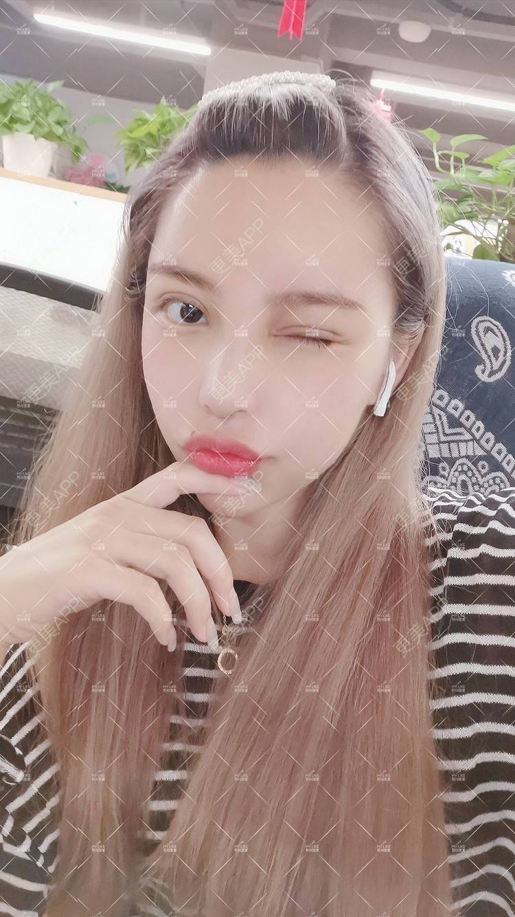 更美 - 土豆泥泥泥的双眼皮经验 | 双眼皮 | 隆鼻 | 苏州 | 自体脂肪面部填充