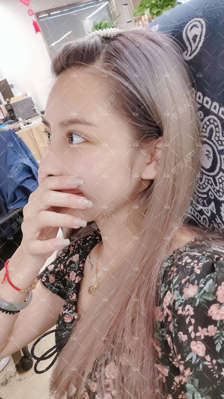 更美 - 土豆泥泥泥的双眼皮经验 | 双眼皮 | 隆鼻 | 苏州 | 自体脂肪面部填充