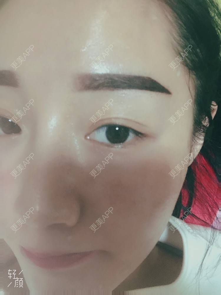 更美 - 更美用户KypVf5ovVE的点阵激光经验 | 上海 | 点阵激光