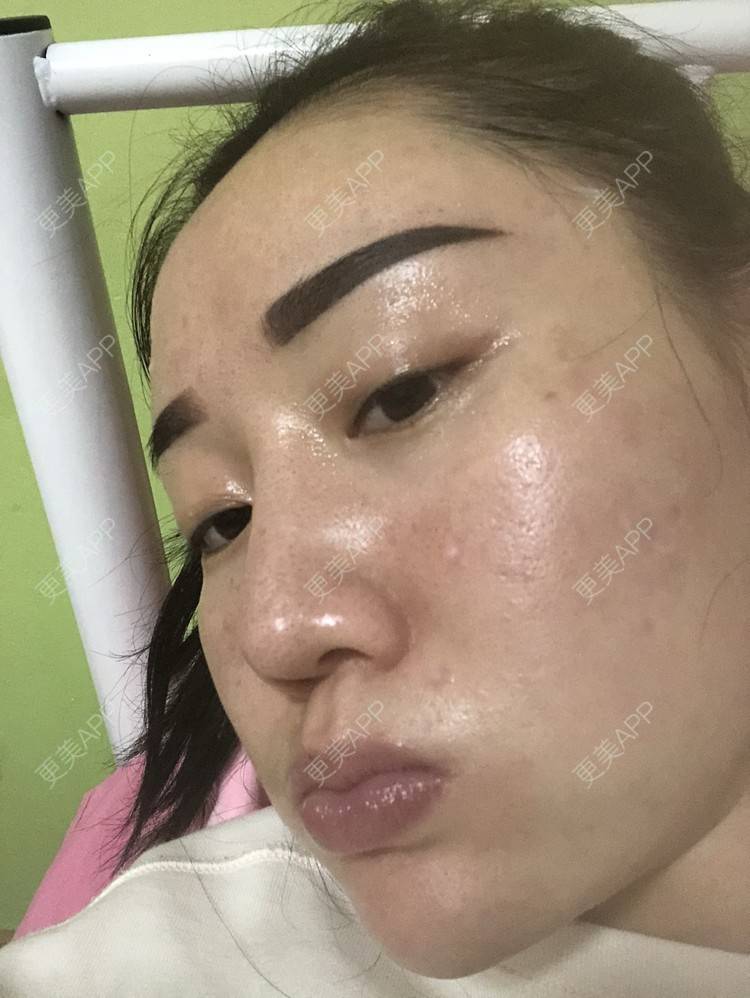 更美 - 更美用户KypVf5ovVE的点阵激光经验 | 上海 | 点阵激光