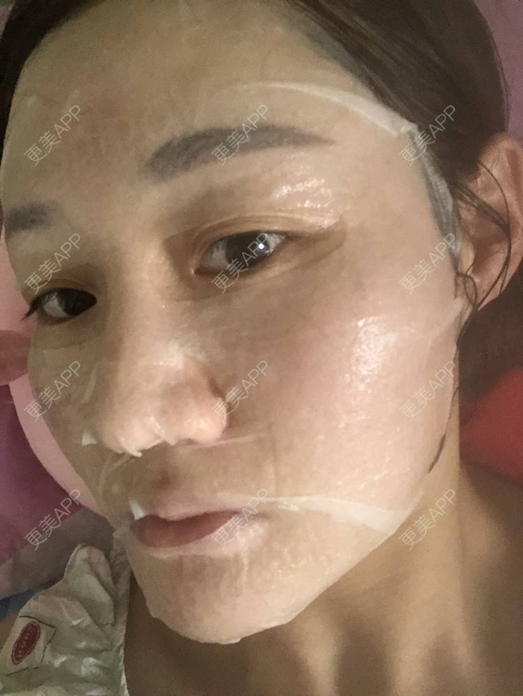 更美 - 更美用户KypVf5ovVE的点阵激光经验 | 上海 | 点阵激光