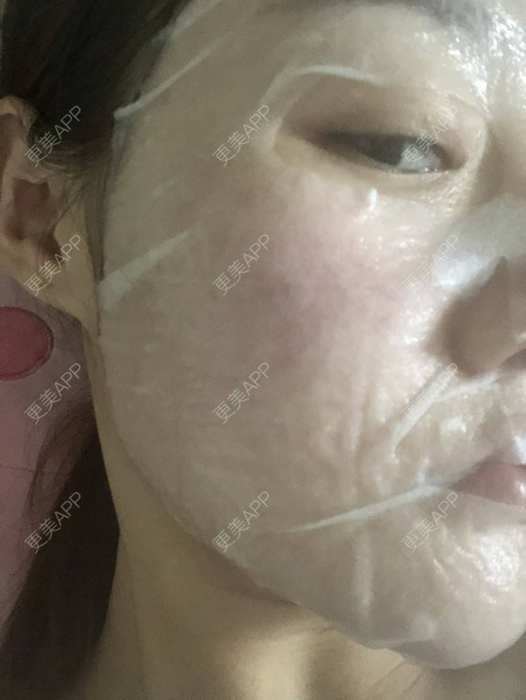 更美 - 更美用户KypVf5ovVE的点阵激光经验 | 上海 | 点阵激光