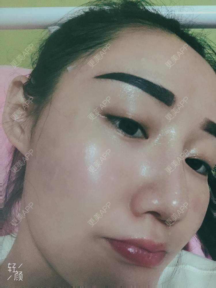 更美 - 更美用户KypVf5ovVE的点阵激光经验 | 上海 | 点阵激光