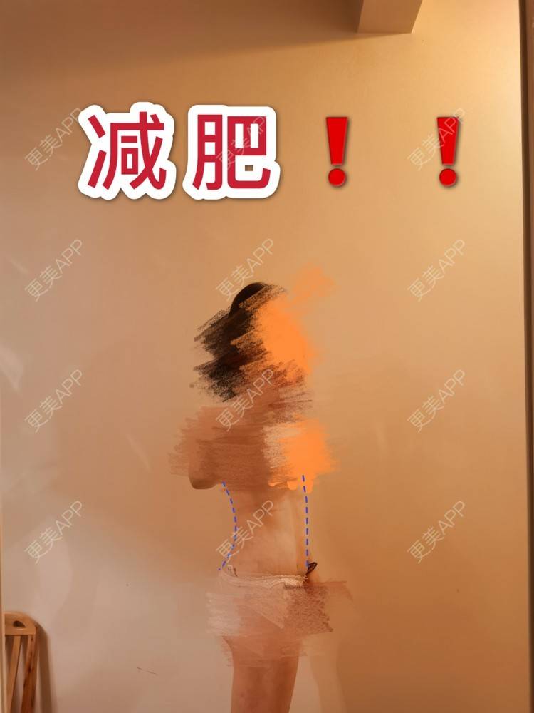 更美 - 更美用户uGcf7IUQa7的腰腹吸脂经验 | 腰腹吸脂 | 背部吸脂 | 手臂吸脂 | 自体脂肪隆胸 | 成都