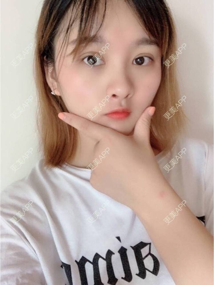 更美 - 更美用户XSgnrDq4CG的玻尿酸套餐经验 | 广州 | 玻尿酸套餐