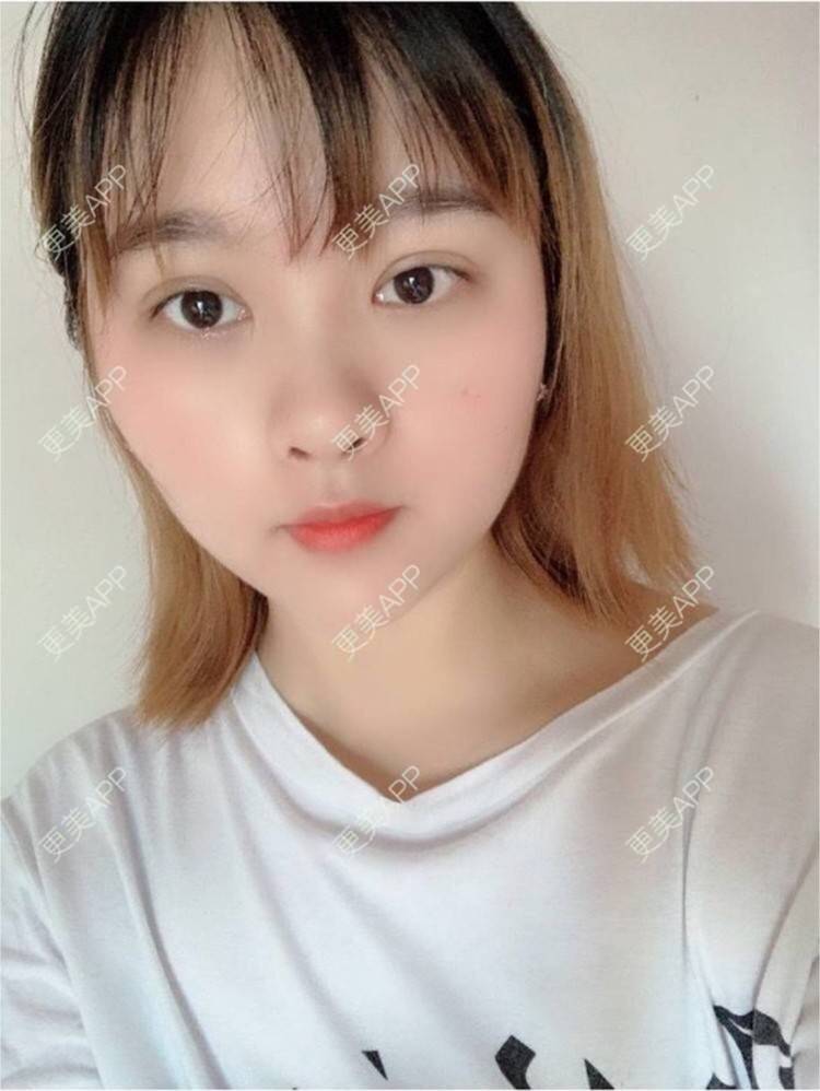更美 - 更美用户XSgnrDq4CG的玻尿酸套餐经验 | 广州 | 玻尿酸套餐