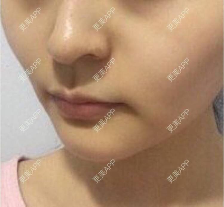 更美 - 更美用户XSgnrDq4CG的玻尿酸套餐经验 | 广州 | 玻尿酸套餐