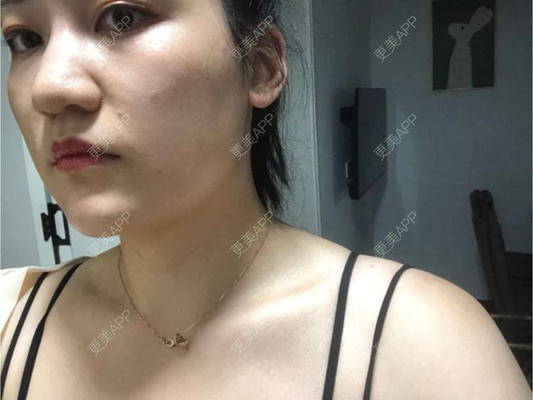 更美 - 阿发4.1的注射塑形腿部经验 | 注射塑形腿部 | 上海