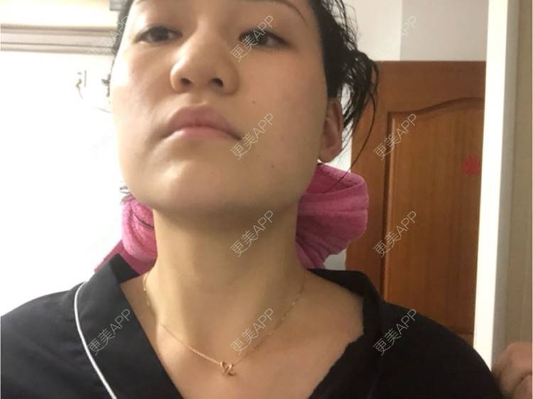 更美 - 阿发4.1的注射塑形腿部经验 | 注射塑形腿部 | 上海
