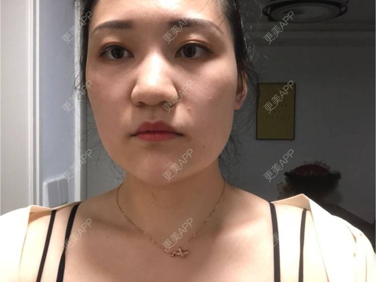 更美 - 阿发4.1的注射塑形腿部经验 | 注射塑形腿部 | 上海