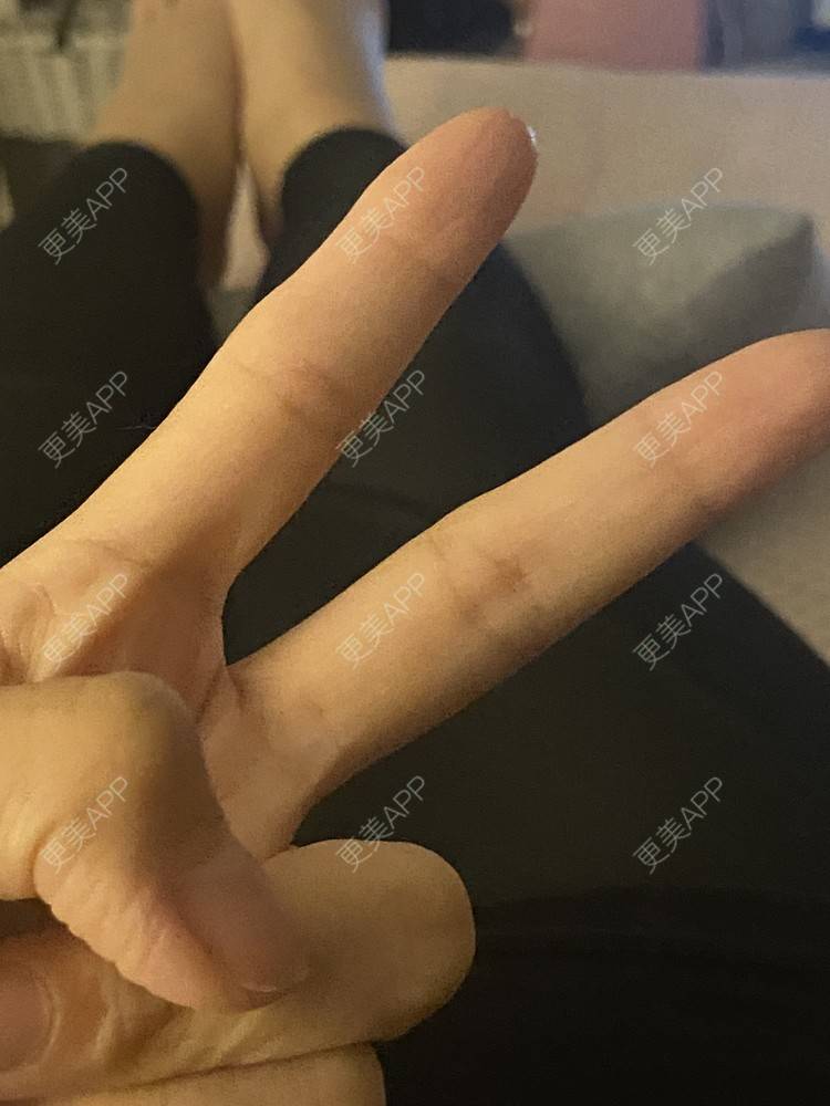 更美 - _ViViLee的吸脂经验 | 吸脂瘦大腿 | 超声溶脂瘦大腿 | 吸脂塑臀 | 吸脂 | 上海 | 射频溶脂瘦大腿