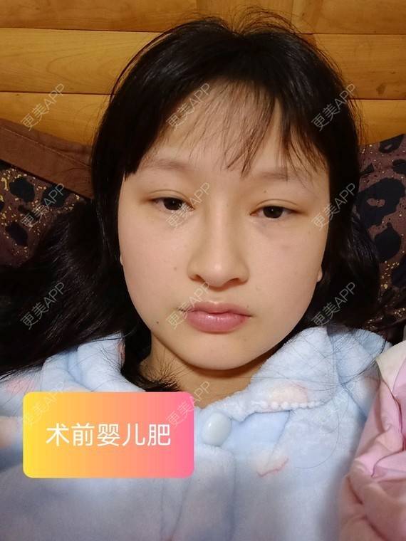 更美 - 更美用户vzqIUiUnop的吸脂瘦脸经验 | 吸脂瘦脸 | 南京