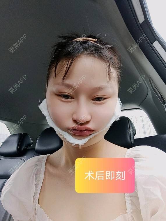 更美 - 更美用户vzqIUiUnop的吸脂瘦脸经验 | 吸脂瘦脸 | 南京