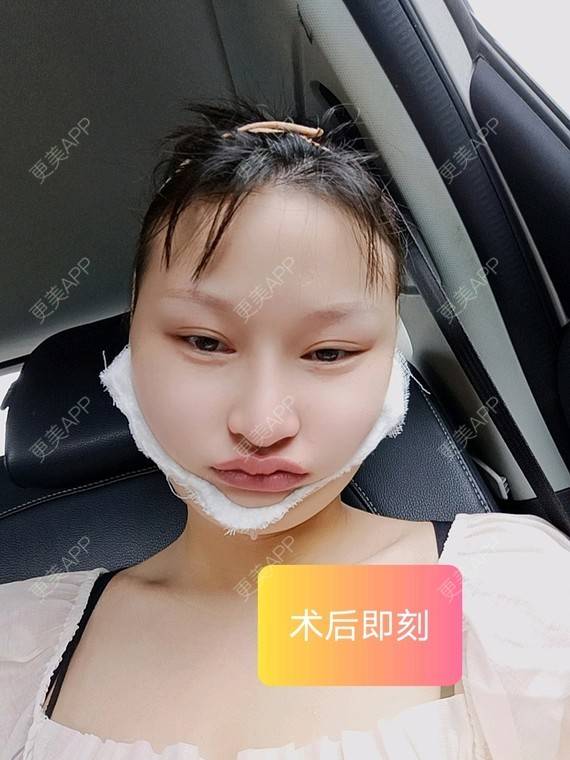 更美 - 更美用户vzqIUiUnop的吸脂瘦脸经验 | 吸脂瘦脸 | 南京