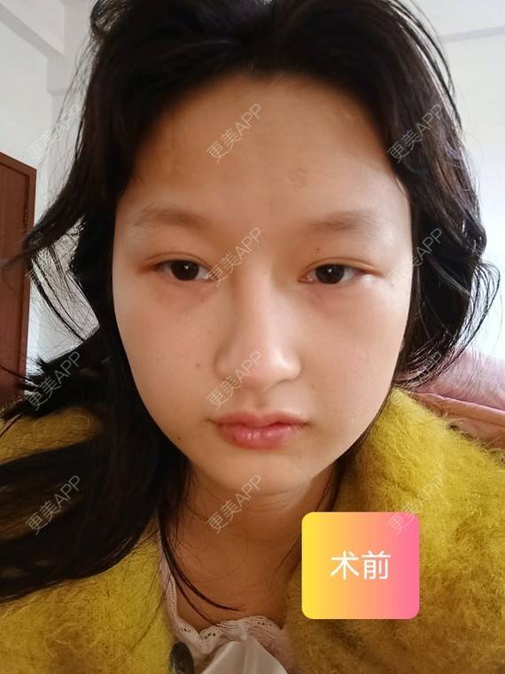 更美 - 更美用户vzqIUiUnop的吸脂瘦脸经验 | 吸脂瘦脸 | 南京