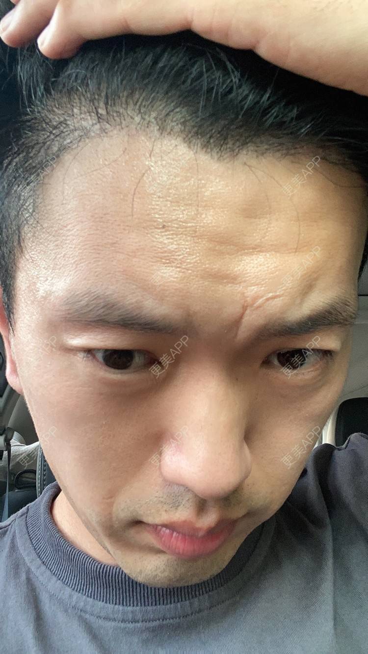 更美用户mws1ir7ert的鬓角植发日记