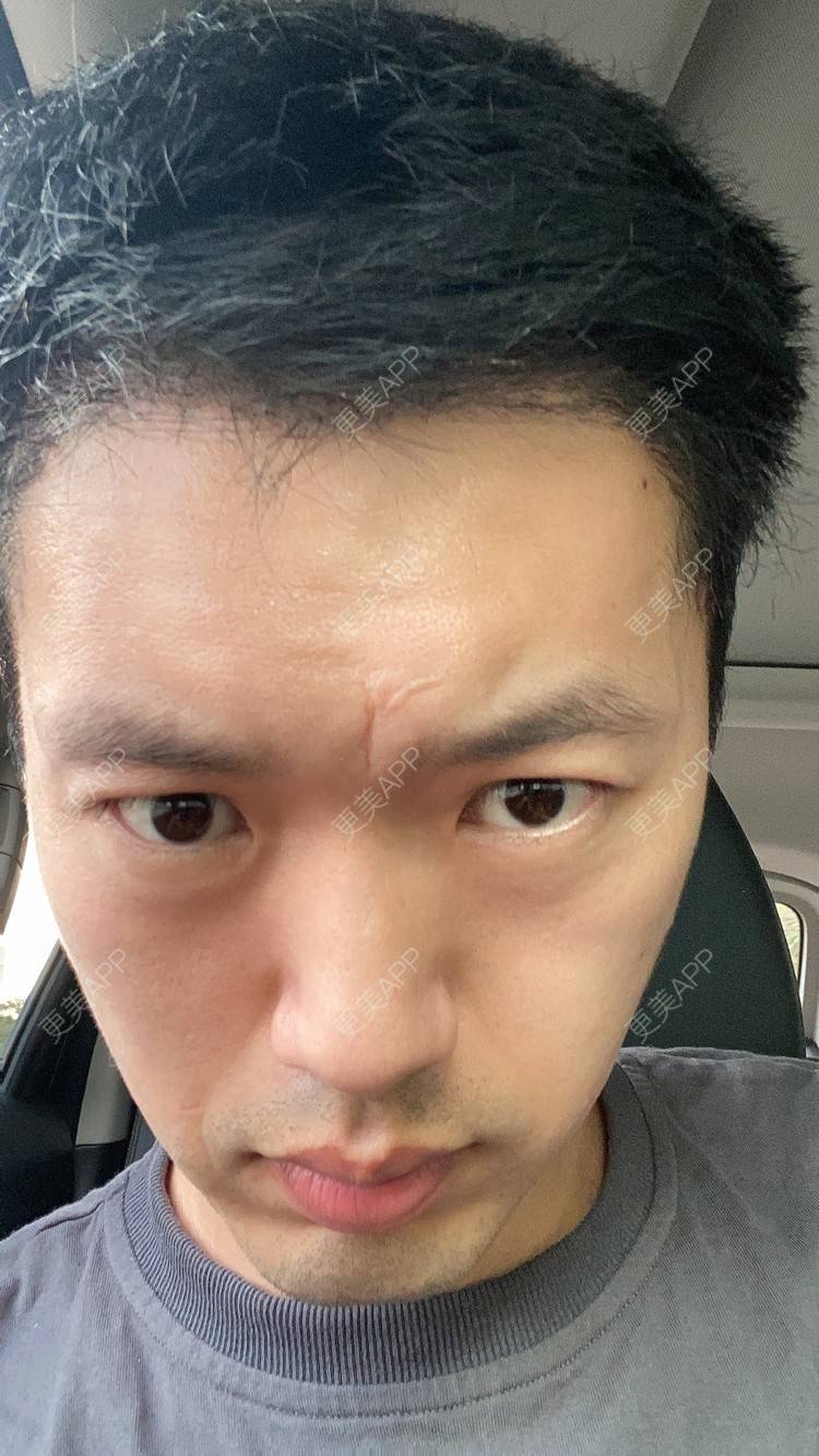 更美用户mws1ir7ert的鬓角植发日记