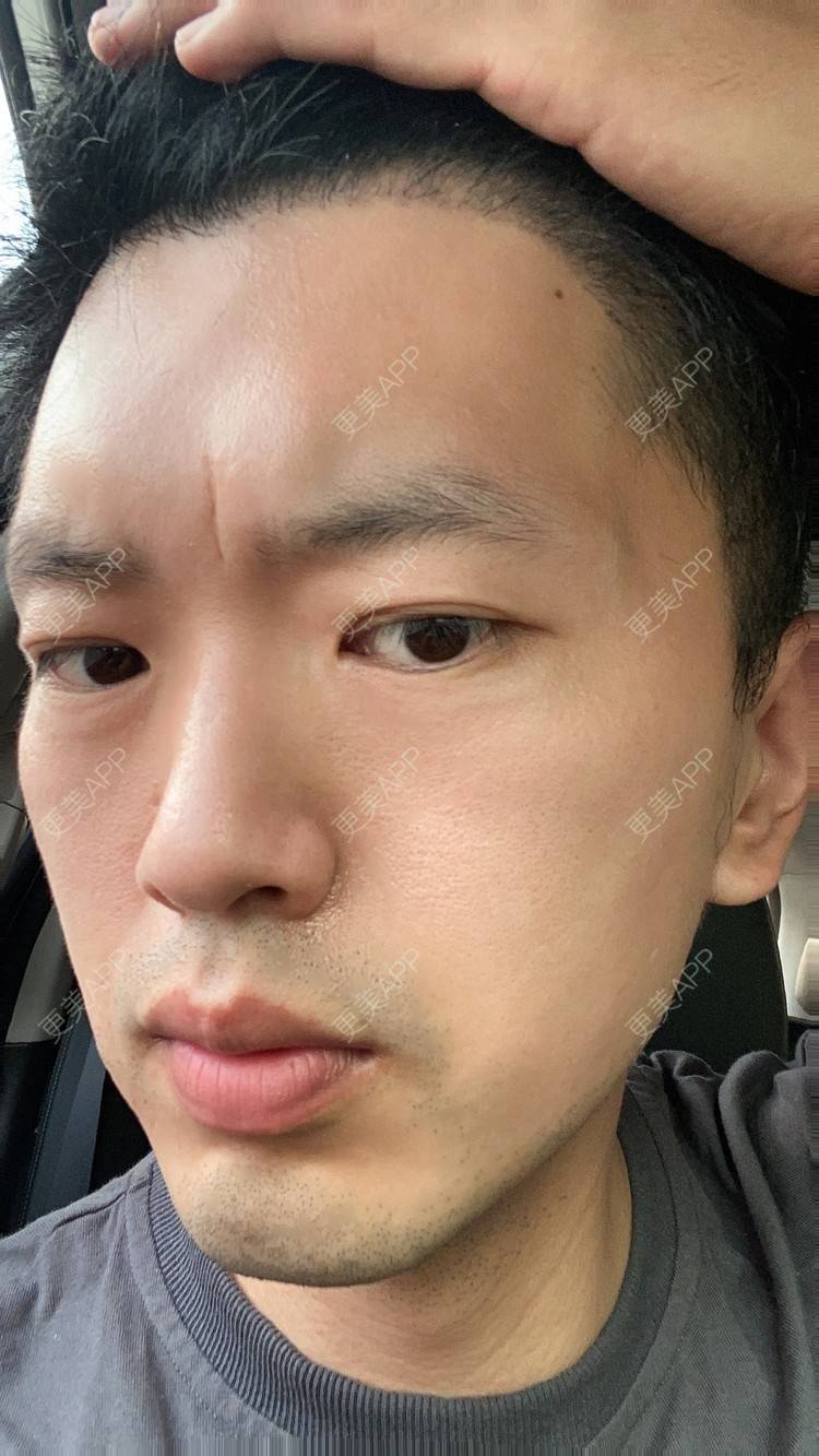 镇江鬓角植发(鬓角植发前后对比照片)