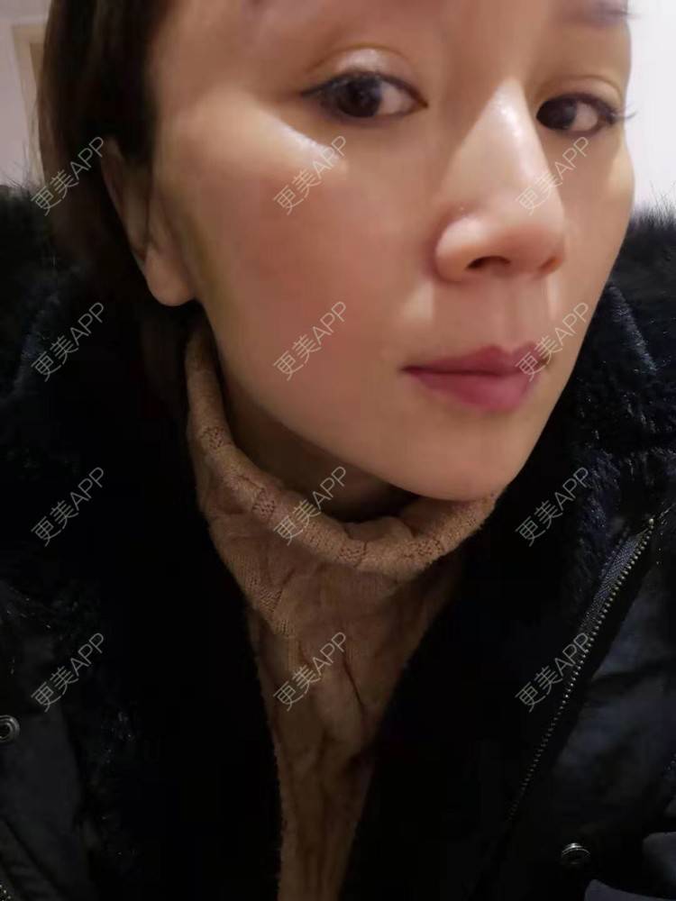 更美 - 更美用户i6Iy8EYag5的除皱经验 | 小切口手术提升 | 拉皮 | 祛皱 | 除皱 | SMAS除皱手术