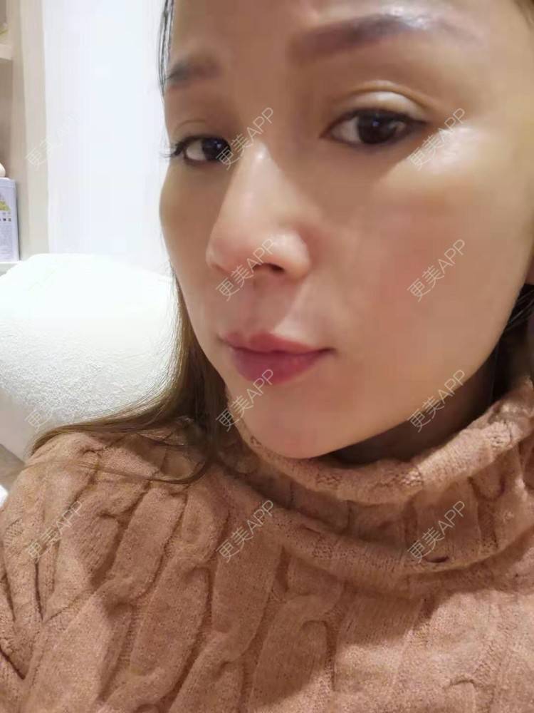 更美 - 更美用户i6Iy8EYag5的除皱经验 | 小切口手术提升 | 拉皮 | 祛皱 | 除皱 | SMAS除皱手术