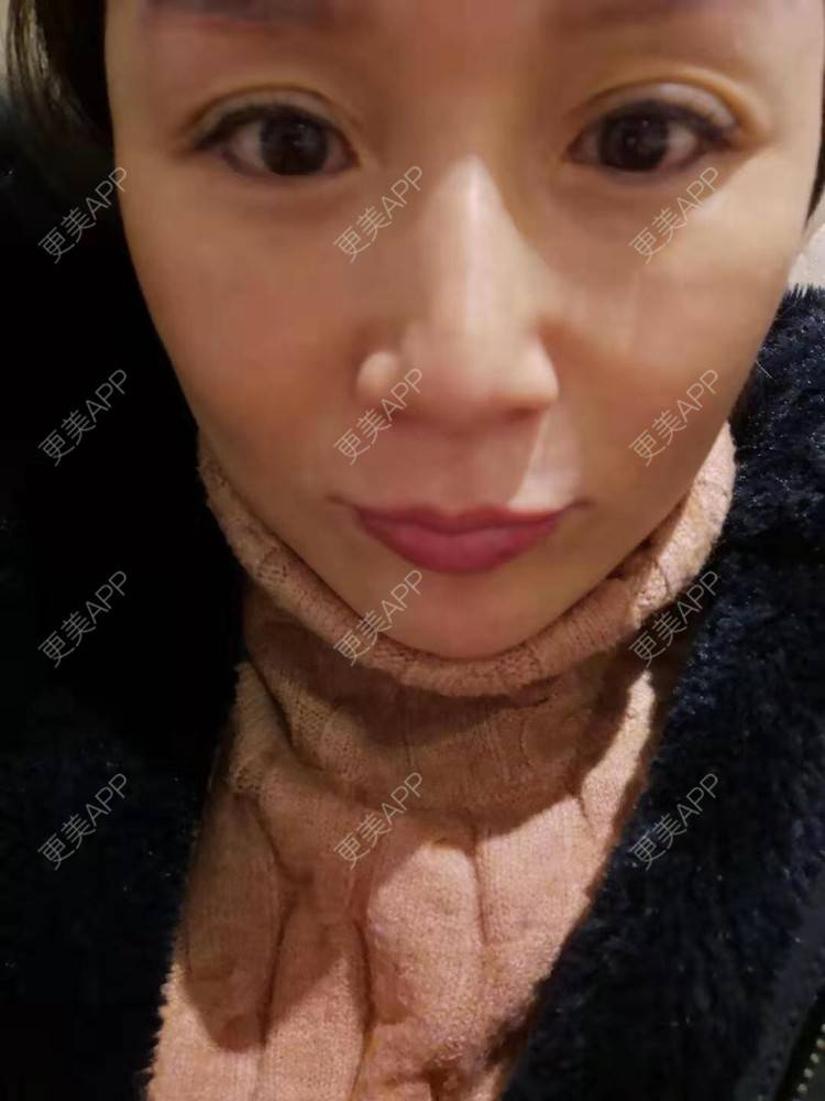 更美 - 更美用户i6Iy8EYag5的除皱经验 | 小切口手术提升 | 拉皮 | 祛皱 | 除皱 | SMAS除皱手术