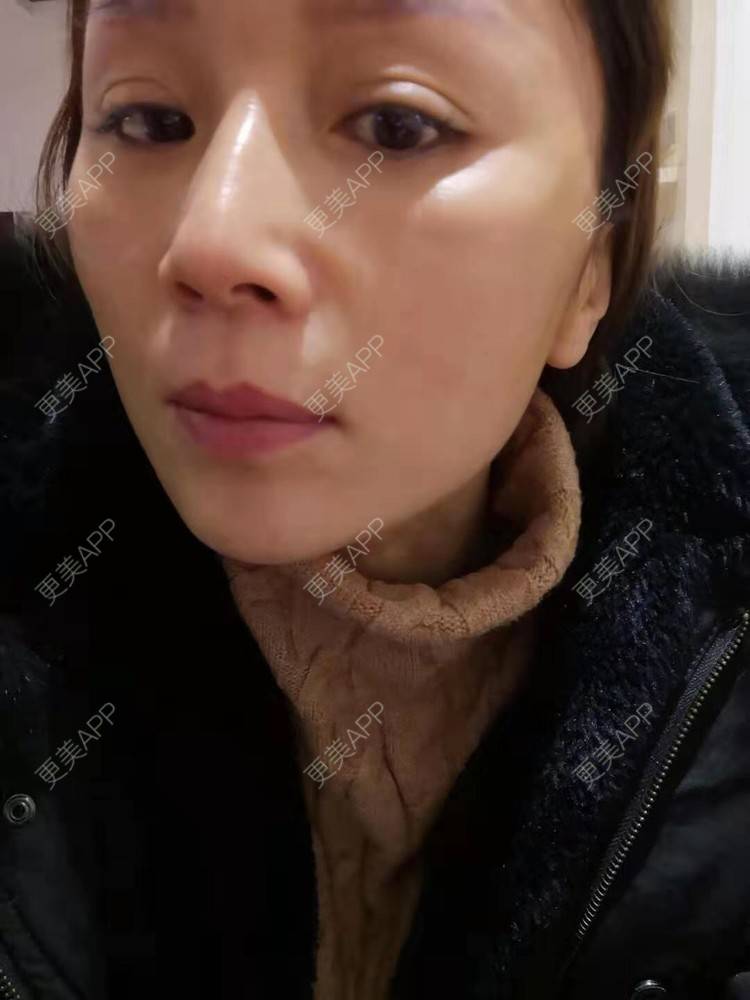 更美 - 更美用户i6Iy8EYag5的除皱经验 | 小切口手术提升 | 拉皮 | 祛皱 | 除皱 | SMAS除皱手术