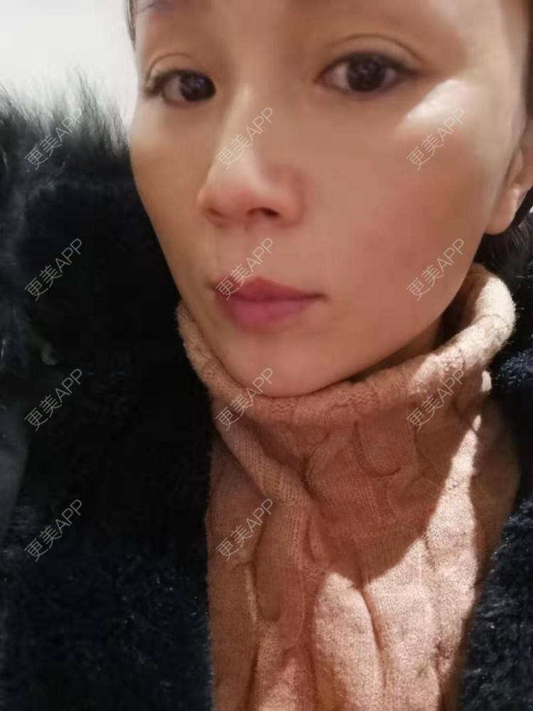 更美 - 更美用户i6Iy8EYag5的除皱经验 | 小切口手术提升 | 拉皮 | 祛皱 | 除皱 | SMAS除皱手术