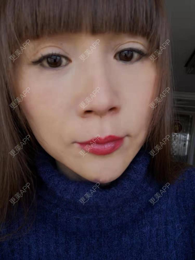 更美 - 更美用户i6Iy8EYag5的除皱经验 | 拉皮 | 小切口手术提升 | SMAS除皱手术 | 祛皱 | 除皱